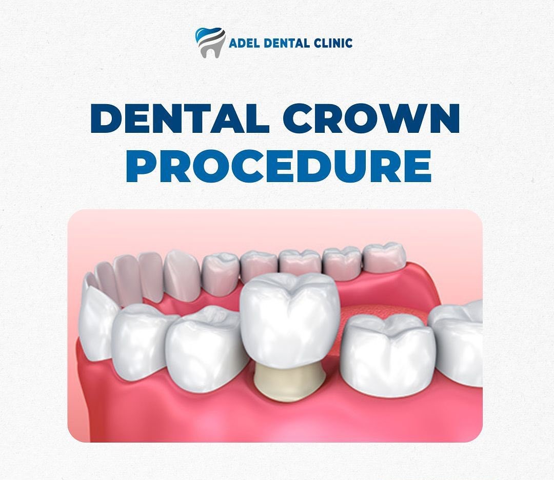 dental crown procedure in Antalya-Turkey